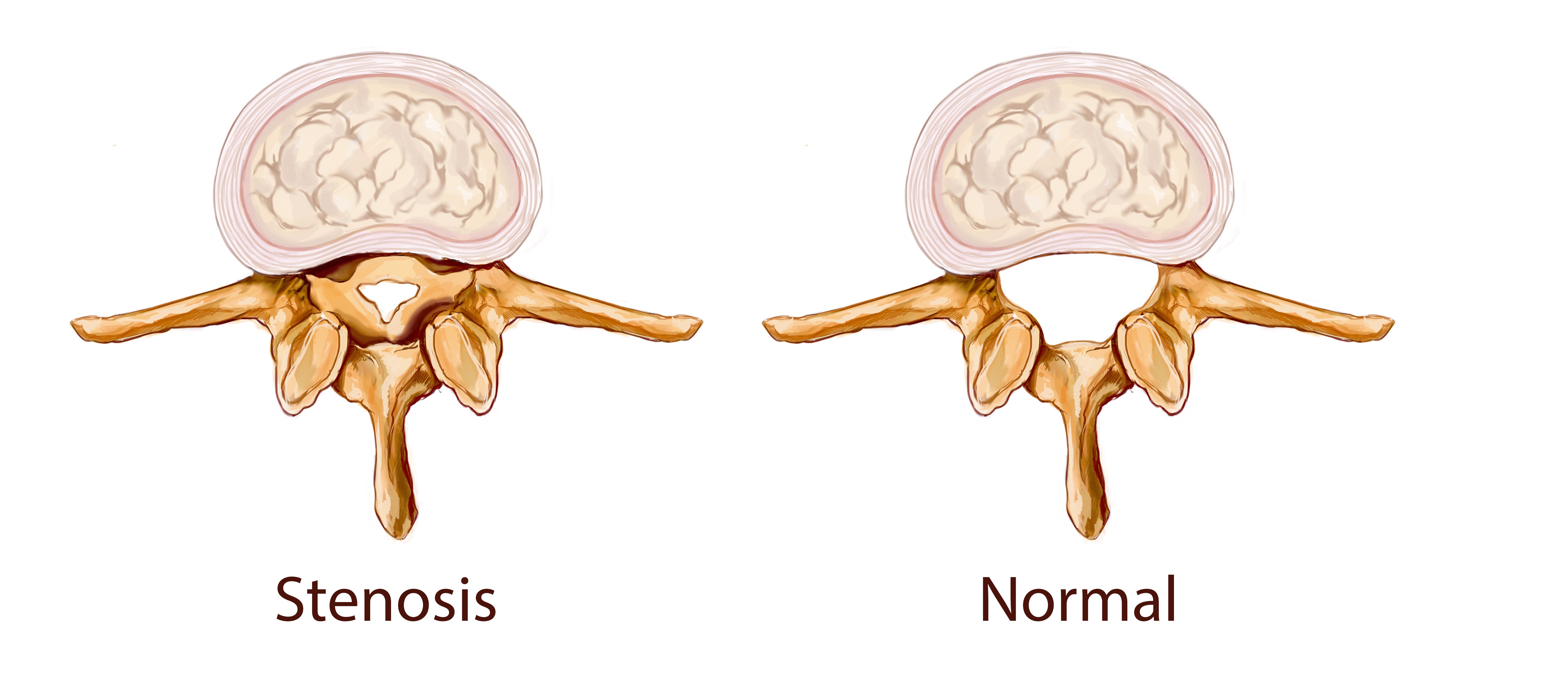 Поясничный позвоночный стеноз. Позвоночный канал шейного отдела позвоночника. Латеральный карман позвоночного канала. Стеноз позвоночного канала. Stenosis латынь.